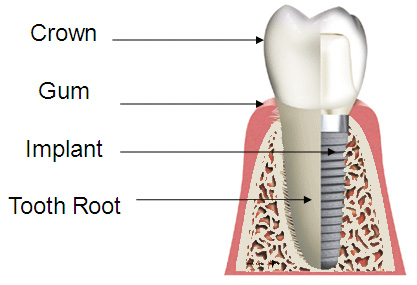 implants