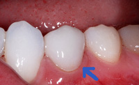 Cerec example 21(2)