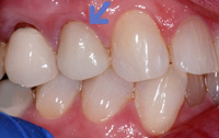 Cerec example 5(2)