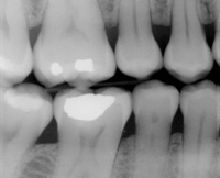 xray example